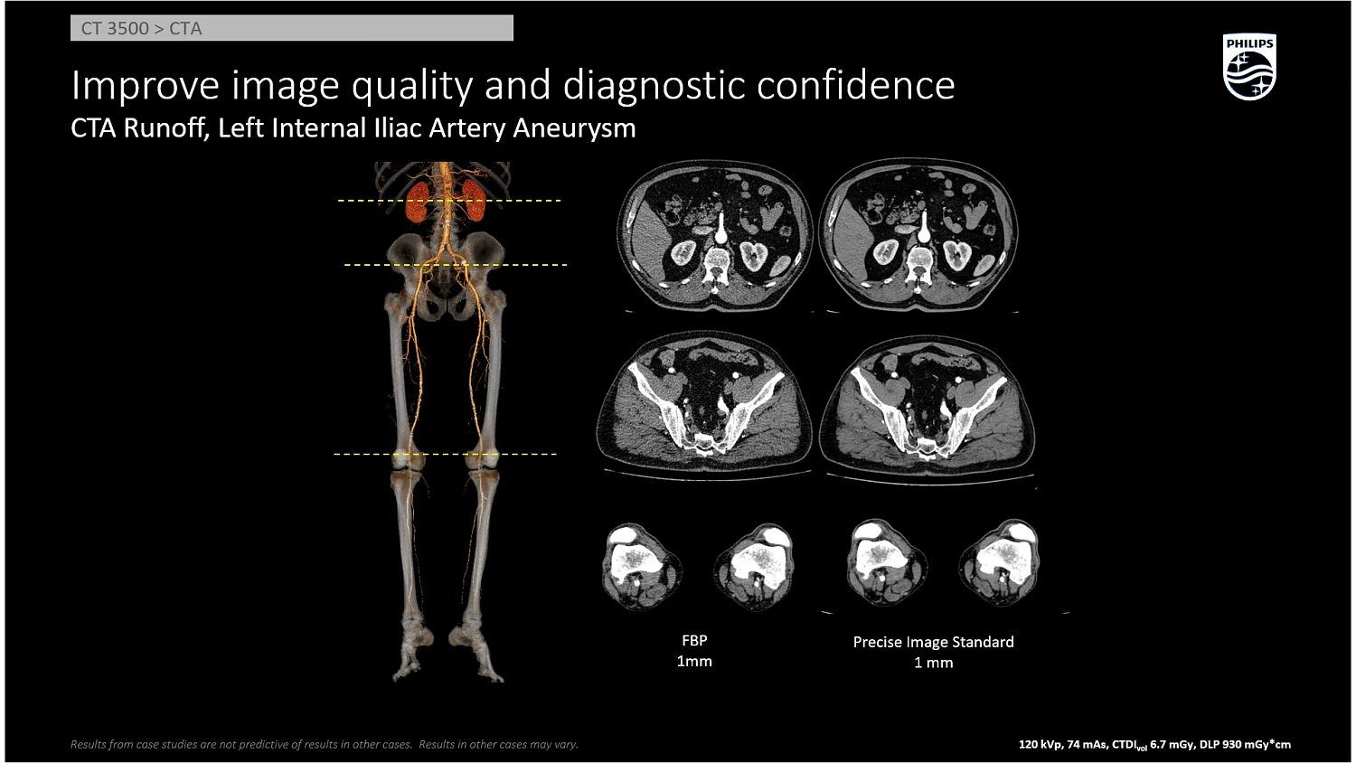 Компьютерный томограф Philips CT 3500