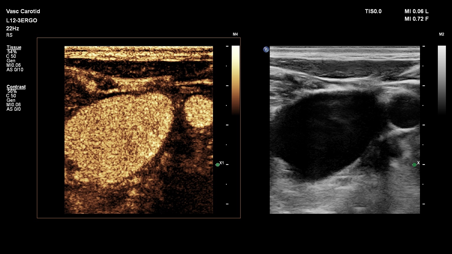 Премиальная ультразвуковая система Philips EPIQ Elite