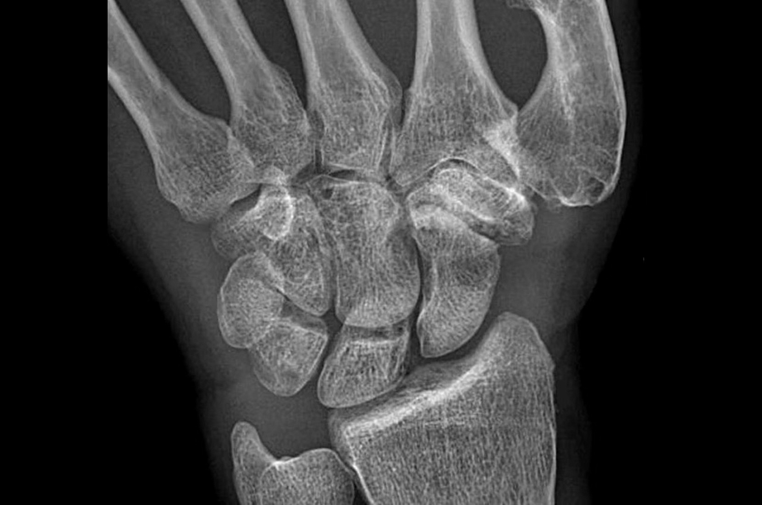 Цифровая рентгенографическая система GE Healthcare Definium Tempo